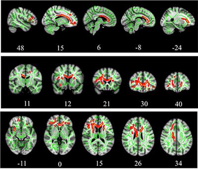 Disruption of white matter integrity and its relationship with cognitive function in non-severe traumatic brain injury